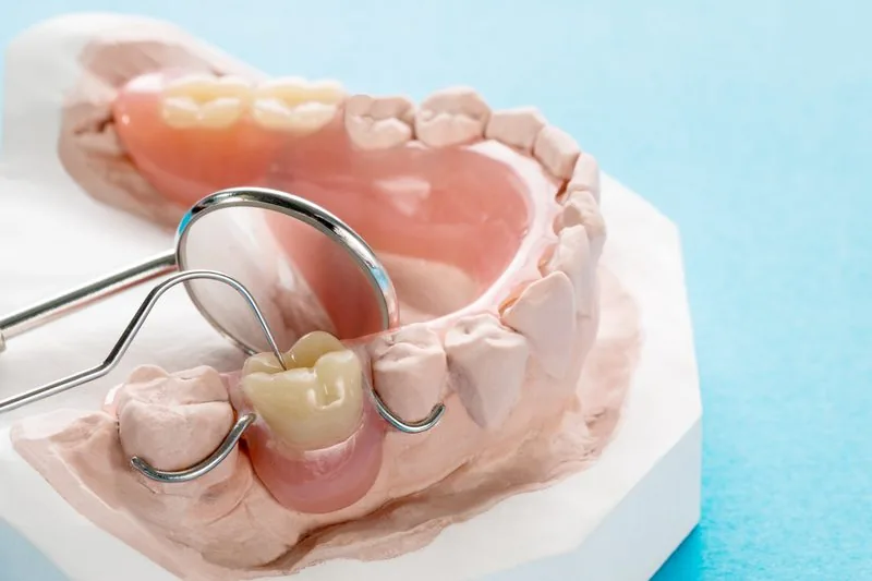 Acrylic partial denture setup and finished dental lab Sydney